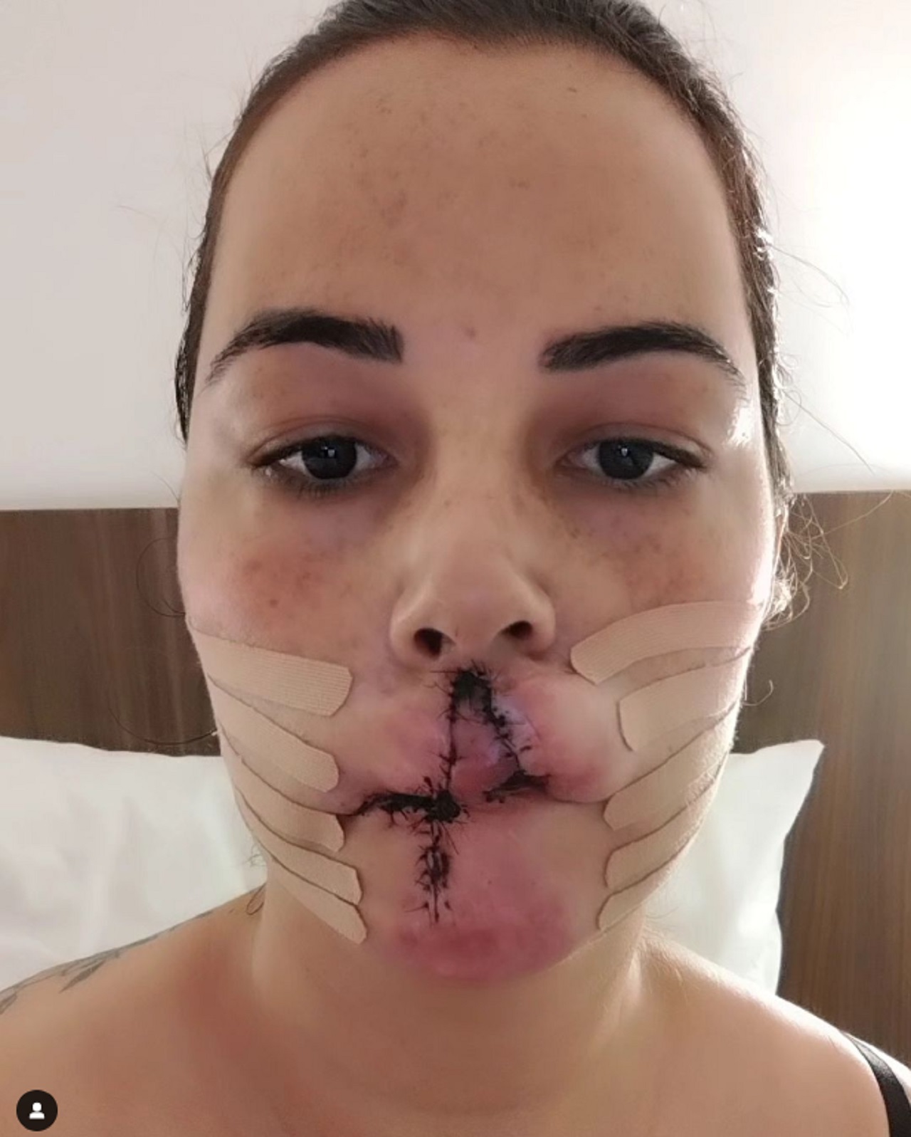 modella perde le lebbra in seguito ad un intervento cosmetico